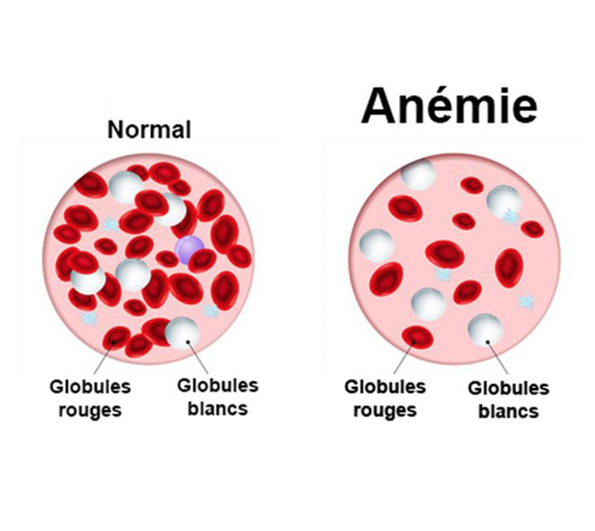 L’anémie est un problème majeur de santé publique
